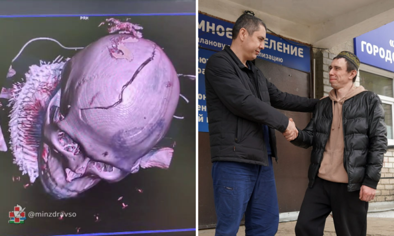 “Череп разлетелся вдребезги”: уральские врачи совершили чудо, спасая жизнь человека - ВЕДОМОСТИ Урал - Новости Екатеринбурга и Свердловской области сегодня