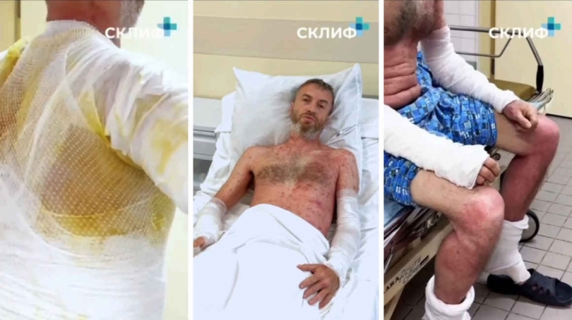 Московские врачи показали, чем опасен борщевик - ВЕДОМОСТИ Урал - Новости Екатеринбурга и Свердловской области сегодня